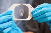 Breaking a sweat: Using chloride in sweat to help diagnose cystic fibrosis