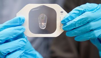 Breaking a sweat: Using chloride in sweat to help diagnose cystic fibrosis