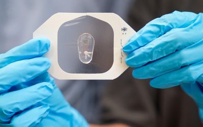 Breaking a sweat: Using chloride in sweat to help diagnose cystic fibrosis