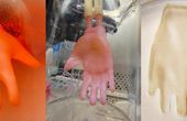 Bioengineered Skin Grafts that Fit Like a Glove