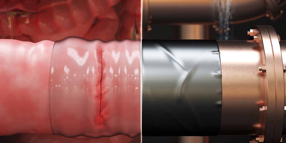 A new MIT-designed surgical sticky tape can be applied quickly and easily, like duct tape to a pipe, to repair leaks and tears in the gastrointestinal tract and other tissues and organs. Credit: Courtesy of the researchers