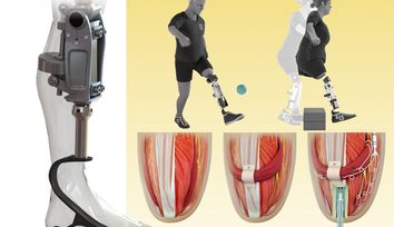 A bionic knee integrated into tissue can restore natural movement
