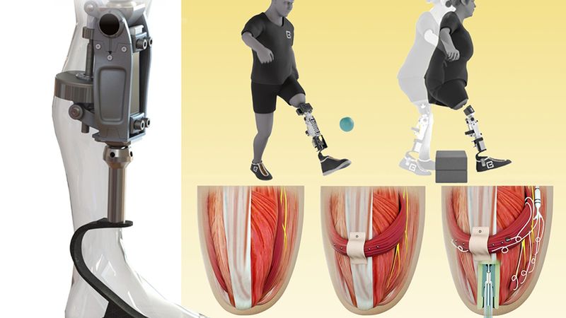 The new bionic knee can help people with above-the-knee amputations walk faster, climb stairs, and avoid obstacles more easily than they could with a traditional prosthesis. The new system is directly integrated with the user’s muscle and bone tissue (bottom row right). This enables greater stability and gives the user much more control over the movement of the prosthesis. Credit: Courtesy of the researchers; MIT News