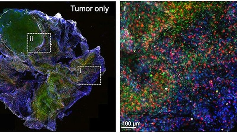 LEFT: A 3D printed tumouroid after 48-hour incubation with immune cells. RIGHT: Zoomed-in section (i) shows the immune cells (in green and red) infiltrating the 3D printed tumouroids.