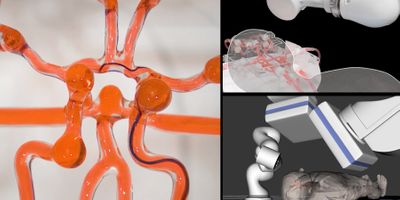 MIT engineers developed a telerobotic system to help surgeons remotely treat patients experiencing stroke or aneurysm. With a modified joystick, surgeons may control a robotic arm at another hospital to operate on a patient. Courtesy of the researchers