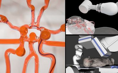 Joystick-operated robot could help surgeons treat stroke remotely