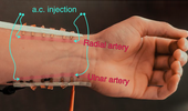 Blood pressure e-tattoo promises continuous, unobtrusive monitoring