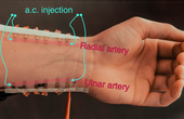 Blood pressure e-tattoo promises continuous, unobtrusive monitoring