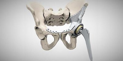 Figure 1: 3D printed hip implant. (Source: MTAA)