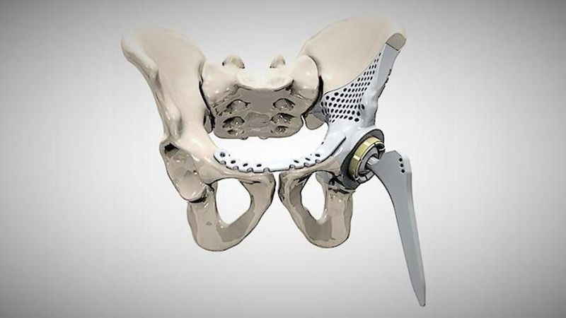 Figure 1: 3D printed hip implant. (Source: MTAA)