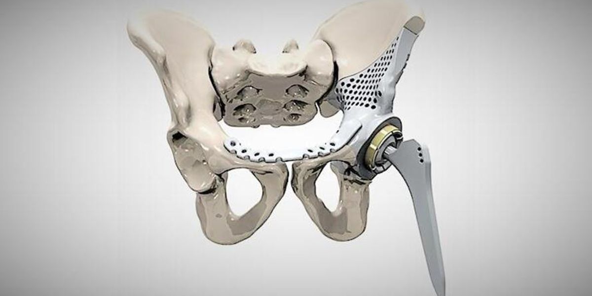 Figure 1: 3D printed hip implant. (Source: MTAA)