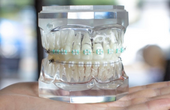 LightForce Orthodontics Brings to Market Fully-Custom Dental Braces
