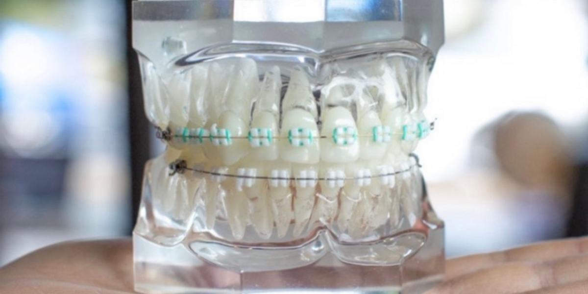 LightForce Orthodontics Brings to Market Fully-Custom Dental Braces