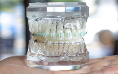 LightForce Orthodontics Brings to Market Fully-Custom Dental Braces