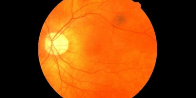 Retinal Scans to Predict Cardiovascular Diseases [Image Credit: University of Leeds]