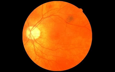 Can Retinal Scans Help in Predicting Myocardial Infarction?