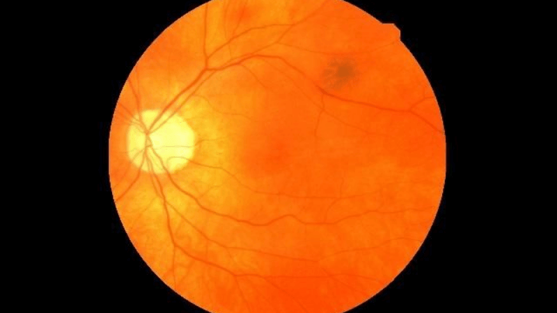 Retinal Scans to Predict Cardiovascular Diseases [Image Credit: University of Leeds]