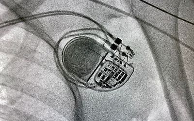 The Heartbeat of Innovation: How the RV-5028-C7 Medical RTC Module Powers the Next Generation of Implantable Medical Devices