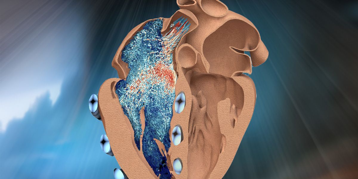 A new bio-robotic model developed by MIT engineers simulates the function of the heart’s lesser-known right ventricle (illustrated here in cross-section, as seen from a front view, on the left). Soft, balloon-like “muscles” (in blue) wrap around and contract the ventricle, mimicking its real pumping action. The model could help to test new implants and devices to treat a range of cardiac disorders. Credit: Courtesy of the researchers