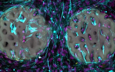 Is the bone implant of the future a hydrogel?