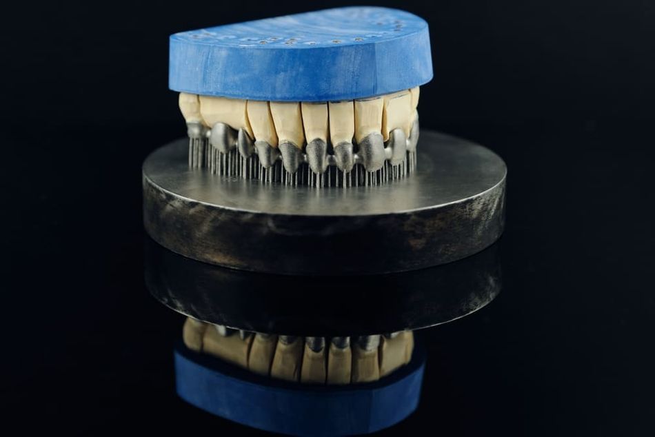 Tooth dental crowns created on a 3d SLS printer form metal. Gypsum model on a printed metal frame