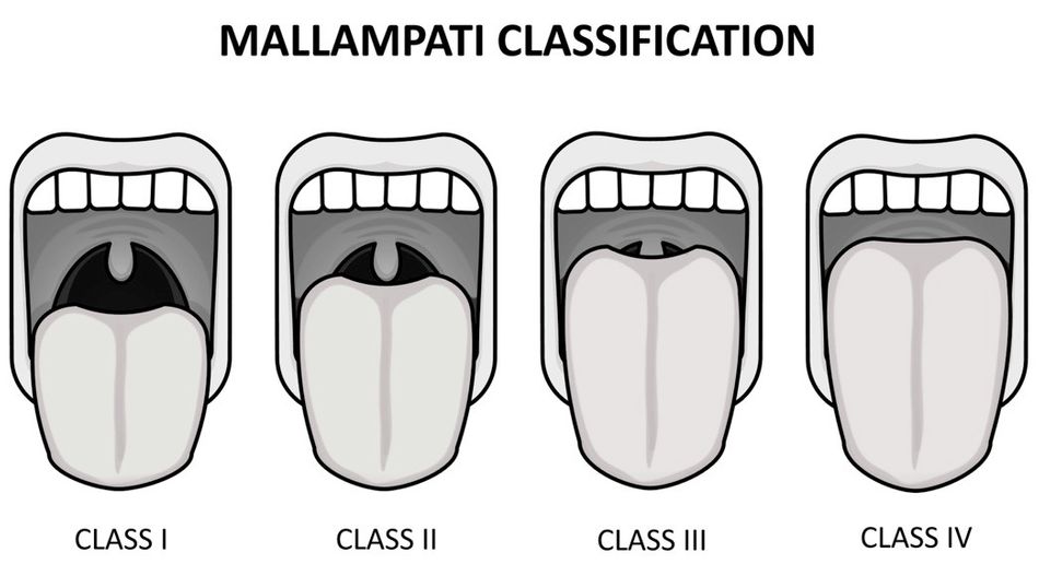 A sample of Mallampati Classification that classifies the throat condition in up to four different classes