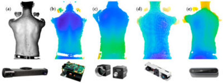 3D back shape captures from Photoneo MotionCam-3D and other 3D vision technologies