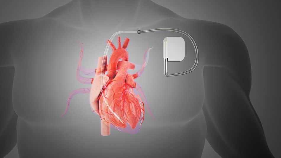 High-voltage monitoring in implantable cardiac devices like pacemakers (Credit: SimpleChips)