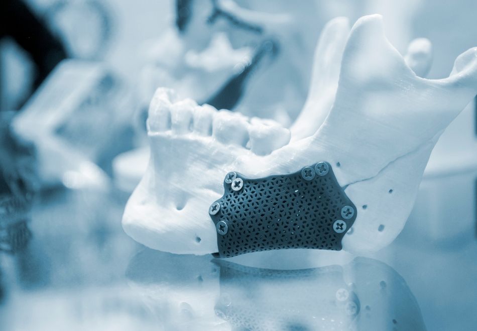 A titanium 3D printed jaw implant.